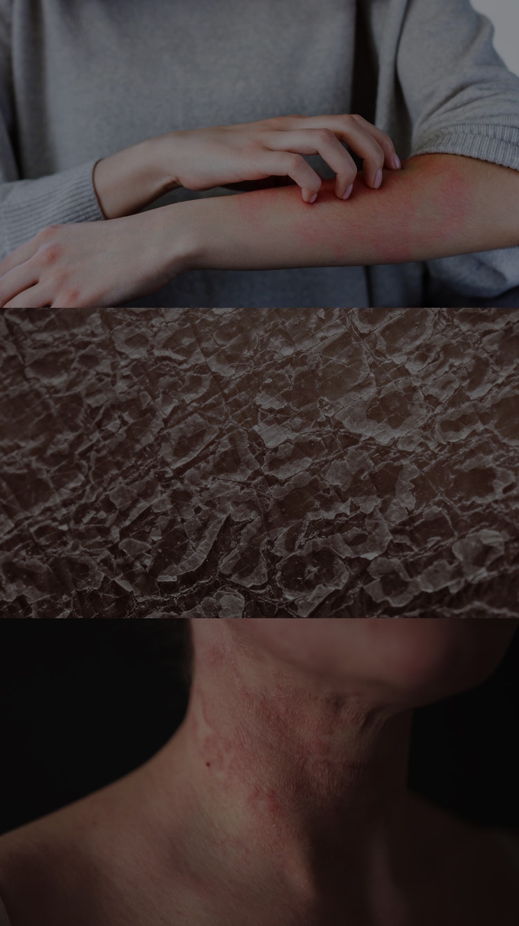 The severity of atopic dermatitis